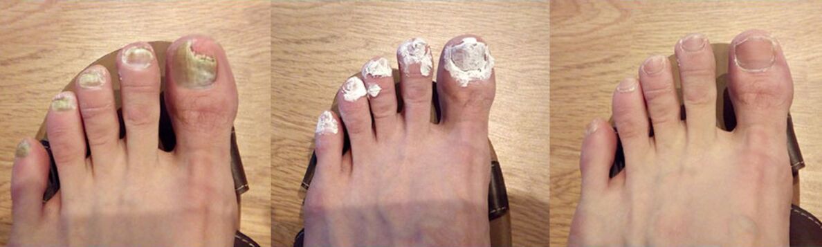 O resultado do tratamento do cogomelo coa radio