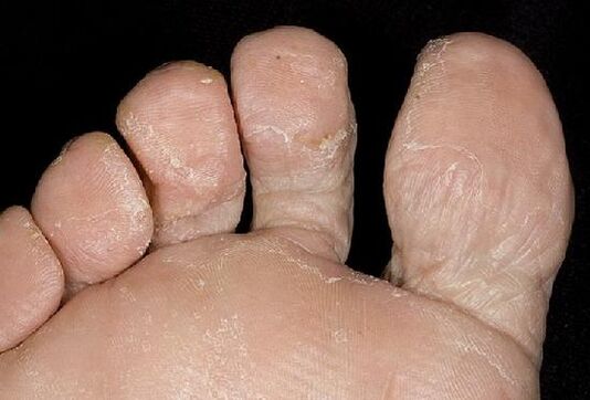 Candidiasis do pé