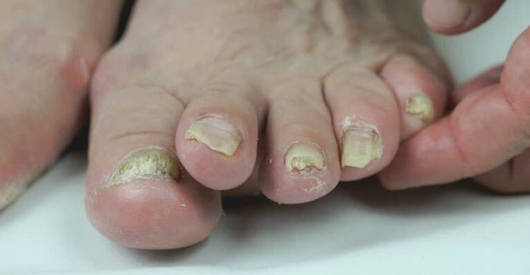 Onicomicosis