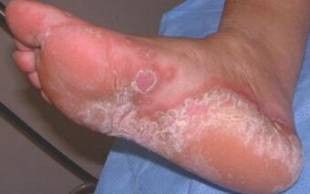 Dermatomicosis aguda do pé