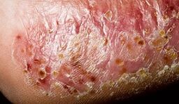 Dermatomicosis