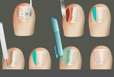 Eliminando a uña en presenza dun cogomelo nas pernas