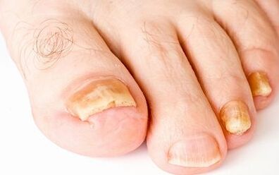 Síntomas fotográficos do fungo das uñas