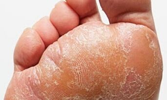 Sinais e síntomas de cogomelos nas pernas